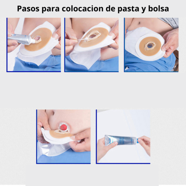 Pasta convatec para fugas en bolsa de colostomia stomahesive